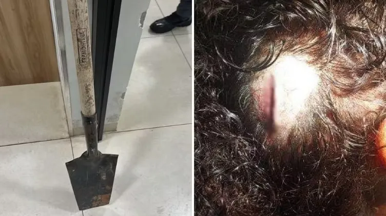 Mulher tem dedo quebrado e sofre cortes na cabeça após ser agredida com pá por homem